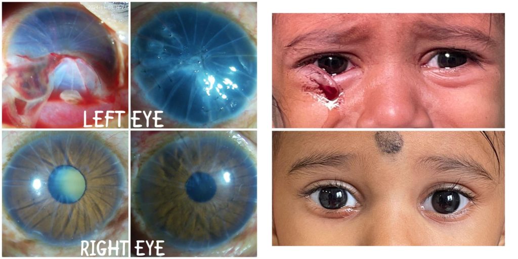 Ocular Trauma